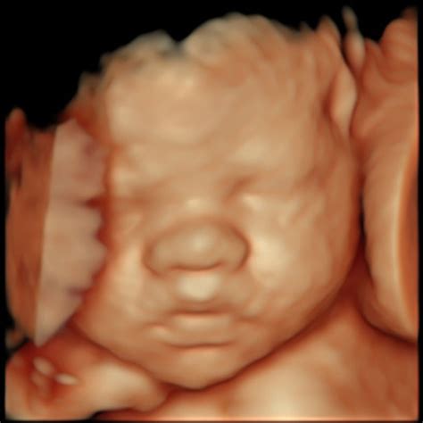 3D/4D Pregnancy Scan - London Pregnancy Clinic