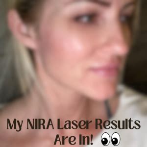 My NIRA Pro Laser Results: Before And After Pictures! (+25% Off Code ...