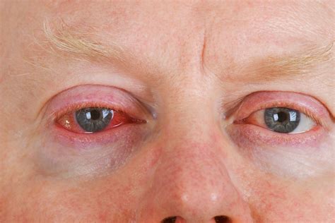 Bloodshot Eyes: Should you be concerned? - Kadrmas Eye Care New England