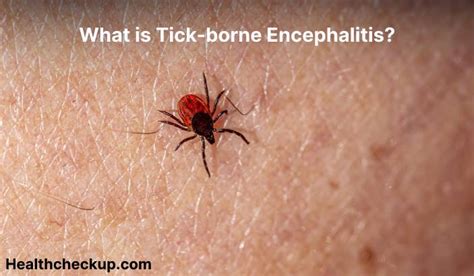 Tick-borne encephalitis (TBE) - Symptoms, Diagnosis, Treatment ...