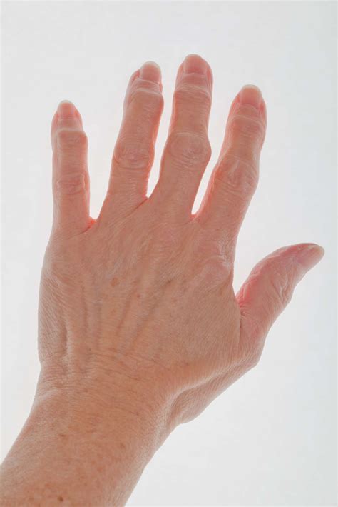 Early Arthritis in Fingers: Symptoms and Treatment