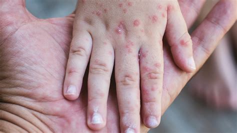 ID Transmission - Preventing - Is Measles Making a Comeback?