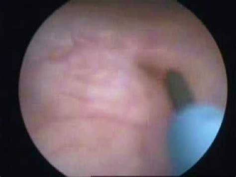 Ureteric stenting (DJ stent bypass) for blockage in kidney passage. - YouTube