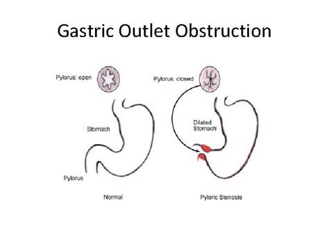 GASTRIC OUTLET OBSTRUCTION AND ITS SURGICAL MANAGEMENT DEFINITION