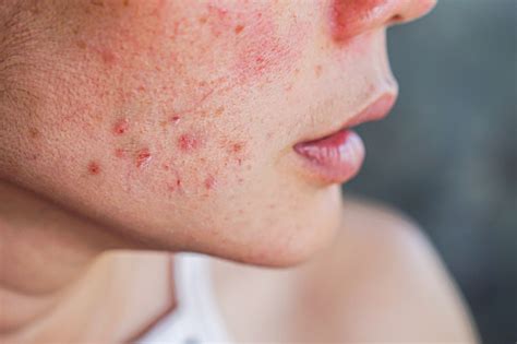 What Is Acne? Symptoms, Causes, Treatments, & More - GoodRx