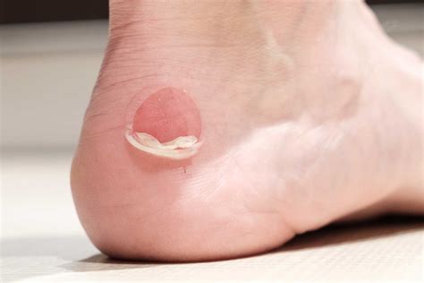 Foot Blisters - How do they form and why? How to treat and prevent. | Algeos