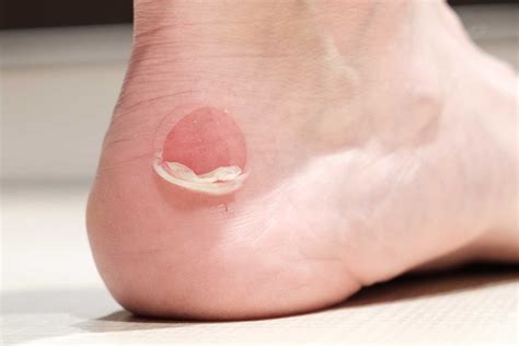 Understanding Foot Blisters | Algeos