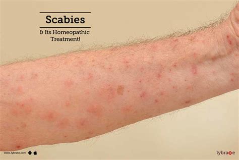 Scabies & Its Homeopathic Treatment! - By Dr. S S Tanwar | Lybrate