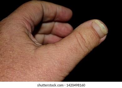 5 Brachydactyly type d Images, Stock Photos & Vectors | Shutterstock