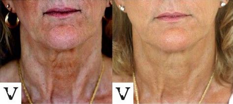 Botox Before And After On Neck | Before And After