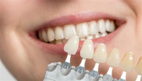 Porcelain Veneers vs. Dental Bonding | Which Is Better?