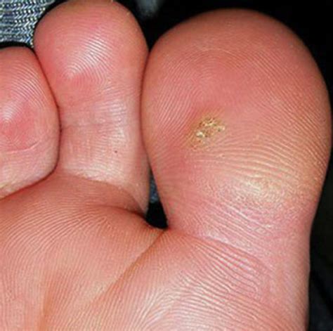 Plantar Warts | Sole Podiatry