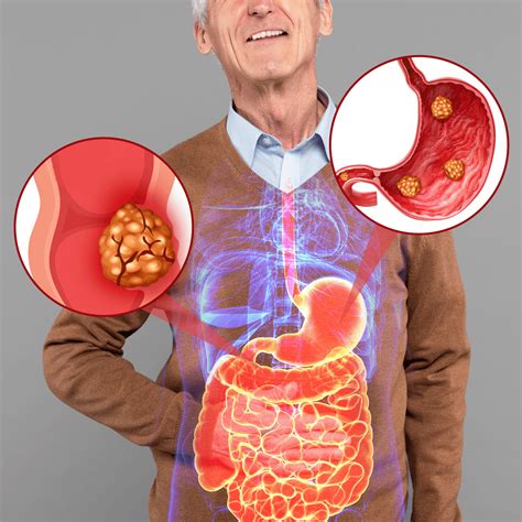 Gastrointestinal Stromal Tumor (GIST): Symptoms & Causes - HealthNile.com