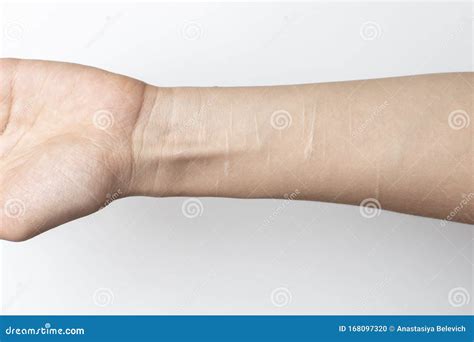 Female Hand Close-up with Scars from Cuts by a Blade Stock Photo ...