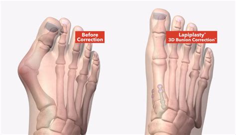 Lapiplasty® 3D Bunion Correction® | Treace Medical Concepts, Inc.