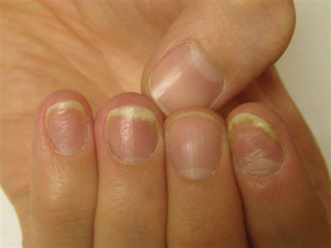 Early nail psoriasis? : r/PsoriaticArthritis