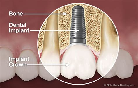 Basal dental implants inchennai: Basal implantology in india - Advantages