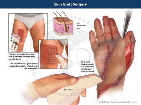 Skin Graft Surgery Illustration by MedDraw Studio | Medical Illustration & Animation