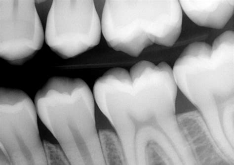 BITEWING XRAYS 10 | buyxraysonline