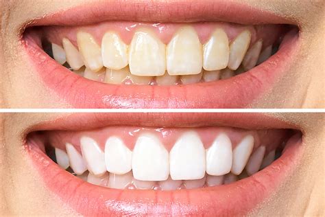 Teeth Whitening for Whiter, Brighter Teeth | Eastgate Dental