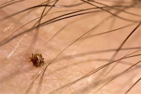 What To Do About Chiggers and Chigger Bites In Mississippi - Synergy²