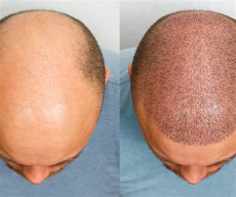 How Much Does 3000 Grafts Hair Transplant Price in Pakistan? - Dr. Zain ...