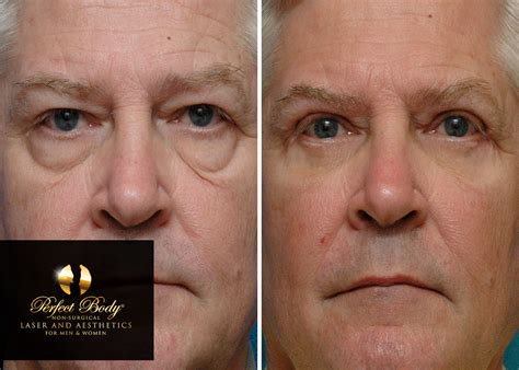 Ultherapy Laser Skin Tightening for the Face | Laser skin tightening ...