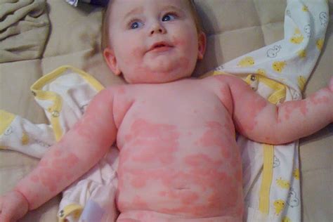 Milk allergy baby neck rash from milk Idea | hostalelportalico