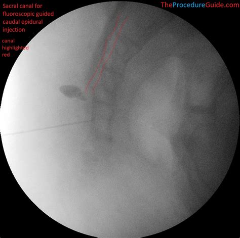 Fluoroscopic Guided Caudal Epidural Steroid Injection – Technique and Overview - The Procedure Guide