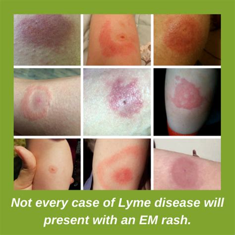 Lyme Disease Tick Bite Rash