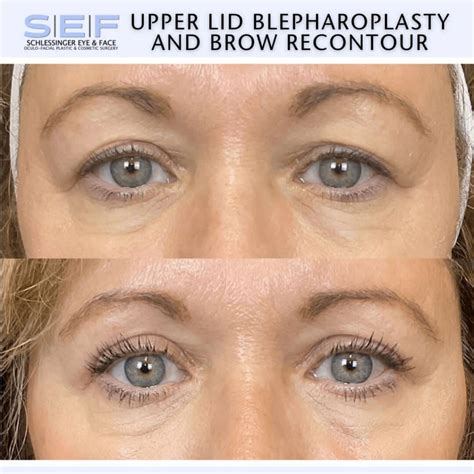 How Long is the Recovery for Eyelid Surgery? : Schlessinger Eye and Face