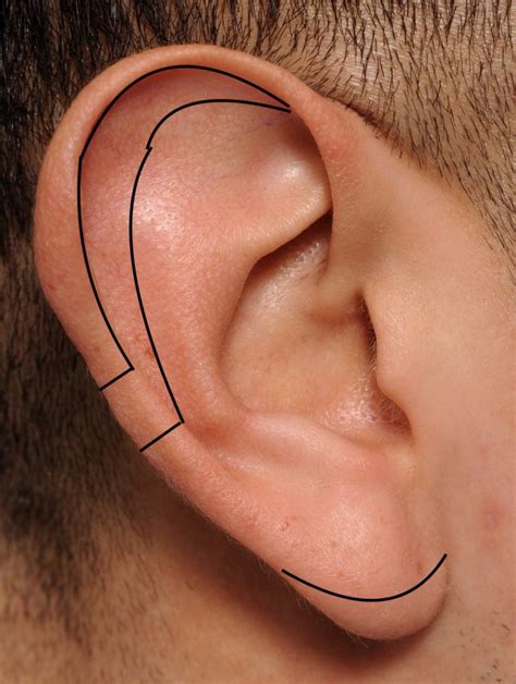 Plastic Surgery Case Study - Central Wedge Resection Technique for Large Concha Macrotia ...