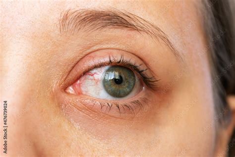 New diagnostic option for rare eye disease