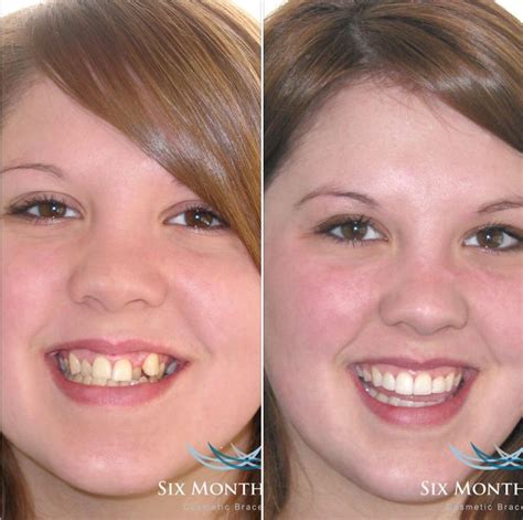 Before and After | Teeth straightening, Orthodontics, Dental