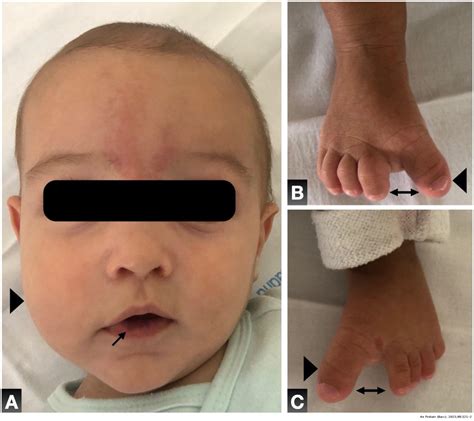 Capillary malformation of the lower lip: CLAPO syndrome | Anales de Pediatría