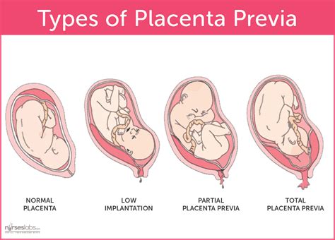 Placenta Previa Nursing Care Plan and Management