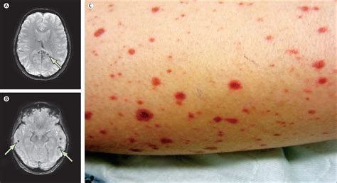 Disseminated varicella zoster virus encephalitis - The Lancet