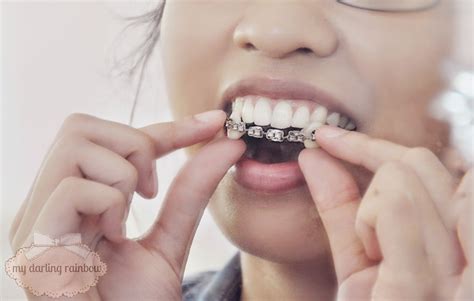 How To Make Homemade Fake Braces / The Dangers Of Fake Braces Diy Braces More Accorde ...