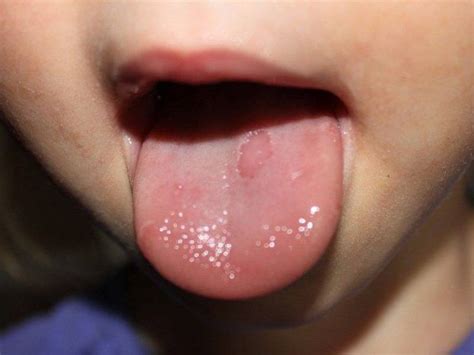 How to treat glossitis: symptoms, treatment of folk remedies, the causes of the disease