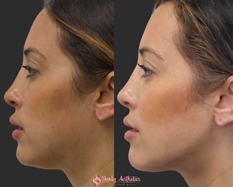 Jawline Fillers - Before & After Results at Skinly