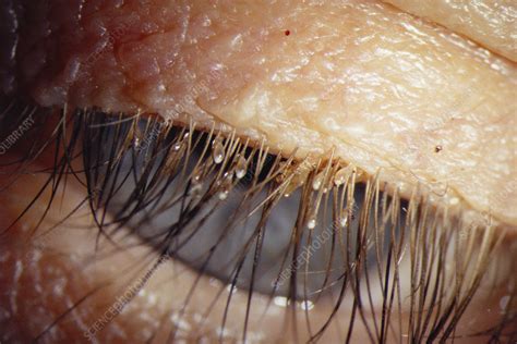 Lice on eyelashes - Stock Image - M240/0424 - Science Photo Library