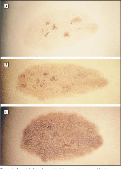 Figure 1 from Speckled lentiginous nevus: within the spectrum of congenital melanocytic nevi ...