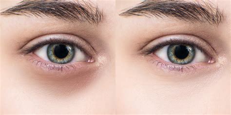 5 Reasons You Have Dark Under Eye Circles & How to Conceal Them – Oxygenetix