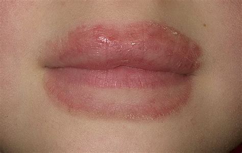 How to treat eczema on lips