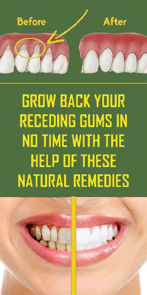 7 Natural Ways To Treat Receding Gums | Receding gums, Natural healing ...