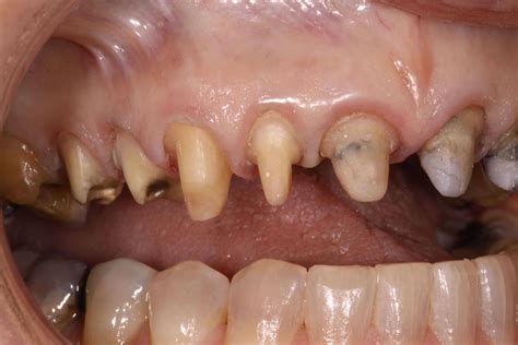 Using Carbides for Crown Preps » Lee Ann Brady, DMD's Dental Blog