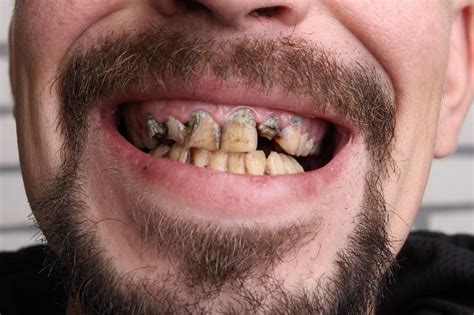 Why Do Meth Addicts Have Bad Teeth | United Recovery