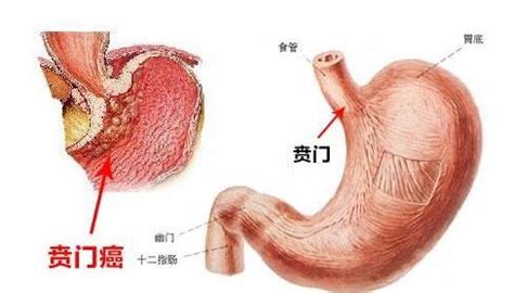 贲门癌能治好吗？ - 知乎