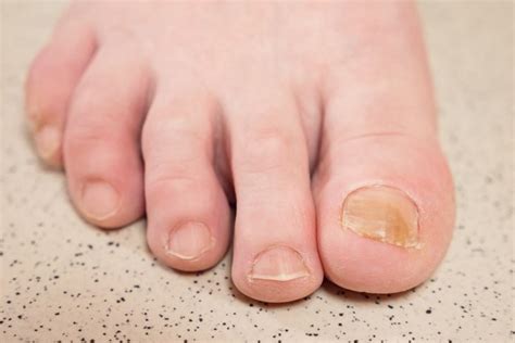 Why Are My Toenails Yellow? - Facty Health