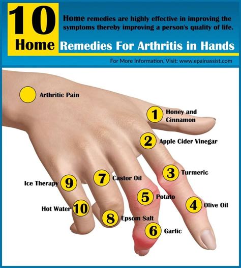 What Causes Arthritis In Hands Check more at http://www.nhprimecare.org ...